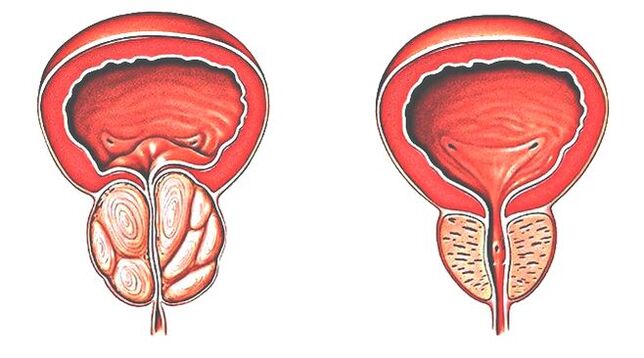 Zapalenie gruczołu krokowego i normalna prostata