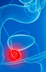 Zapalenie prostaty