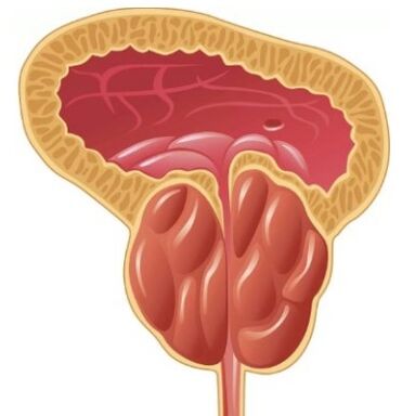 Zapalenie prostaty