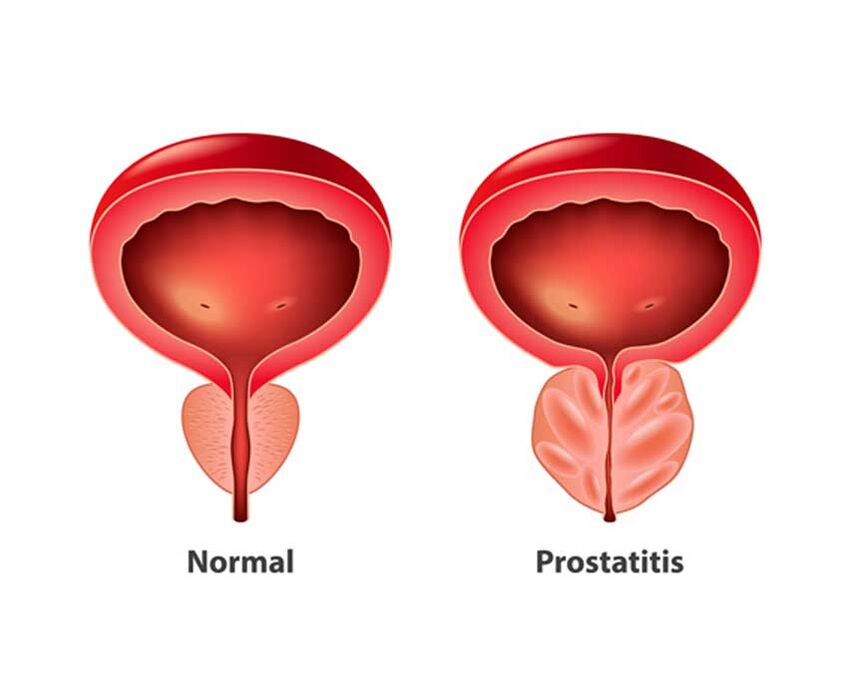 normalna i zapalna prostata