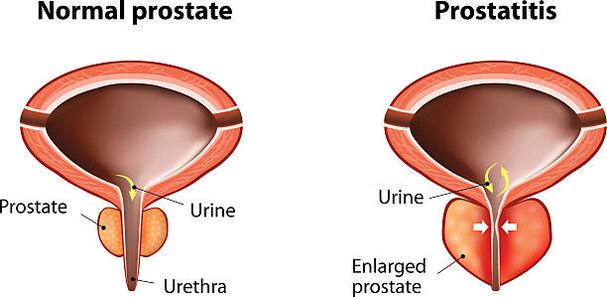 normalna i zapalna prostata